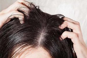 Причина выпадения волос при гепатите thumbnail