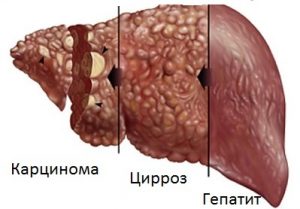 Компьютерная томография печени при гепатите thumbnail