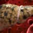 Причины и лечение гепатоза печени